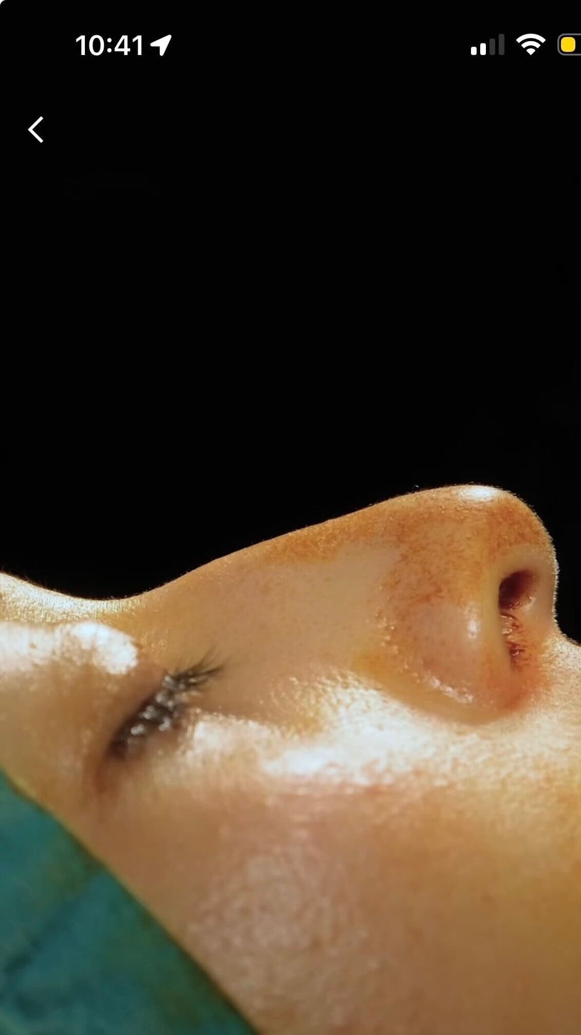 Maya’s nose in profile, pre-op.